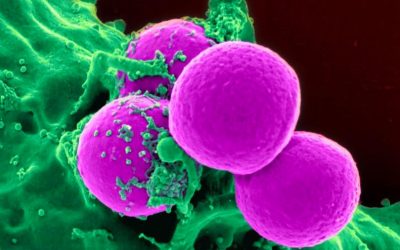 Uso di cellule staminali nella cura del glioblastoma, uno dei tumori più aggressivi del cervello